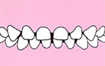 幼少期の歯並び